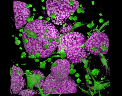 Kaustav Bera (Anseth lab) - Nikon AXR Laser Scanning Confocal. Traditionally, cancer drugs were only tested on tumor cells in isolation without considering effects on surrounding normal cells. We are now developing controlled systems with multiple cell types to better identify life-saving treatments. Here, you can see spheres of tumor-derived cells (pink with cell nuclei in white) surrounded by normal cells (green), allowing us to study tumors in an environment more relevant to our own bodies.