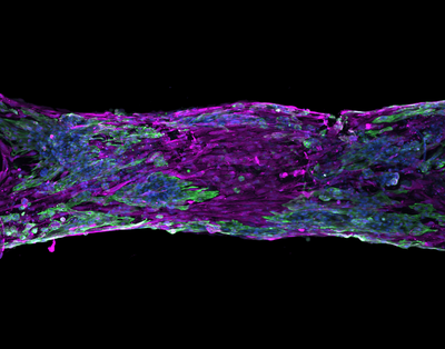 Mackenzie Obenreder (Burdick Lab) - Nikon AXR Laser Scanning Confocal. After a heart attack, the heart develops a scar ("fibrosis") where the muscle cells have died, which can ultimately lead to heart failure. By engineering a model of this scarred heart, we can help test new drugs for reducing the fibrotic region. This is an image of a human stem cell-derived cardiac muscle with a distinct scar region in the  center (magenta only) surrounded by healthy functional tissue shown via fibroblasts (magenta), cardiomyocytes (green), and their nuclei (blue).
