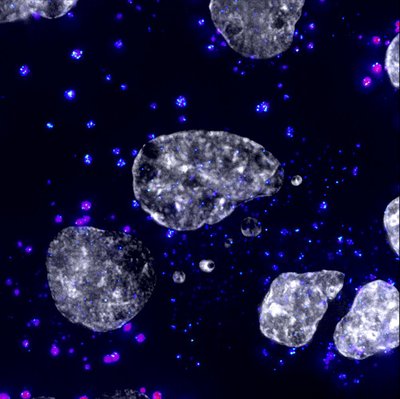 Stephanie Moon (Parker Lab) - Delta Vision Widefield. Messenger RNA is used to convey genetic information from the DNA found in the nucleus of our cells (in white) to ribosomes outside the nucleus. Upon arrival, the mRNA is read to create the proteins that are necessary for our cells and bodies to properly function. However, the mRNA (pink-light blue) can occasionally coalesce into larger, unwanted macro structures dubbed stress granules (dark blue). The presence of stress granules can be observed in patients suffering from cancer as well as diseases that affect the brain and muscles. Here, we are able to quantify the number and the size of the stress granules, providing us insights into how they are formed and possible treatments that can be implemented.