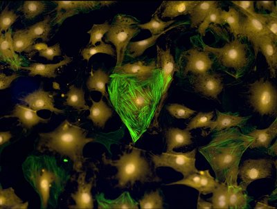 Brian Aguado (Anseth Lab) - PerkinElmer Operetta. Cardiac fibrosis refers to the stiffening of the muscles that make up the human heart and it can lead to cardiac arrest. Researchers have developed laboratory models whereby they can distinguish healthy cells (shown in yellow) from diseased cells (shown in green). The development of such models helps researchers understand and treat cardiac fibrosis.